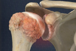 artroza deformanta primara