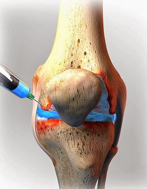infiltratii genunchi gonartroza după ce a mâncat dureri articulare