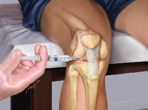 injectii pentru artroza la genunchi