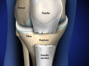 refacerea tendonului rotulian