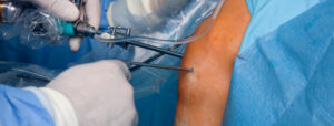 artroscopia - operatia minim invaziva