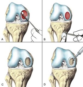 Medicina regenerativă a cartilajului - Refacerea cartilajului (Tehnica AMIC)