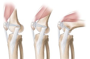 reconstructia ligamentului femuro-patelar intern